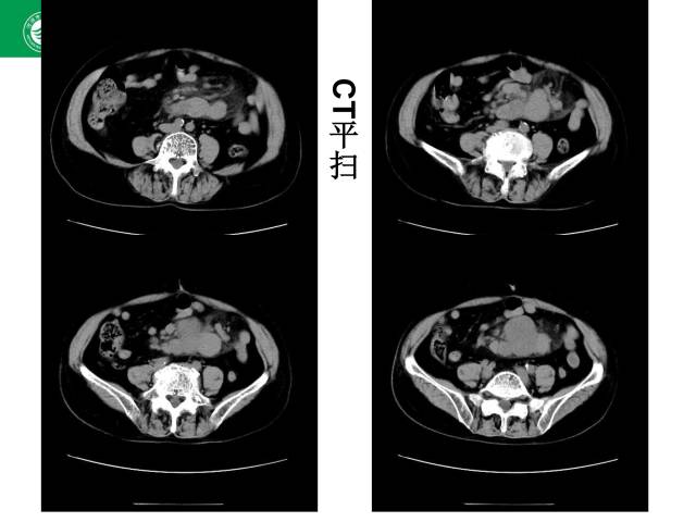 【病例】肠系膜根部淋巴瘤1例CT影像表现 【病例】肠系膜根部淋巴瘤1例CT影像表现