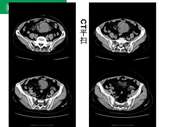 【病例】肠系膜根部淋巴瘤1例CT影像表现 【病例】肠系膜根部淋巴瘤1例CT影像表现