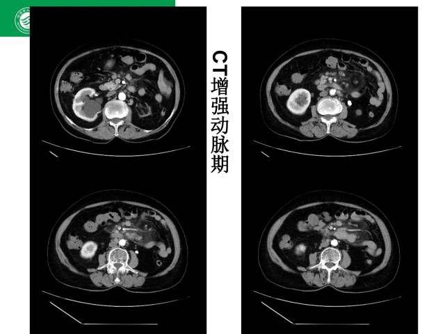 【病例】肠系膜根部淋巴瘤1例CT影像表现 【病例】肠系膜根部淋巴瘤1例CT影像表现