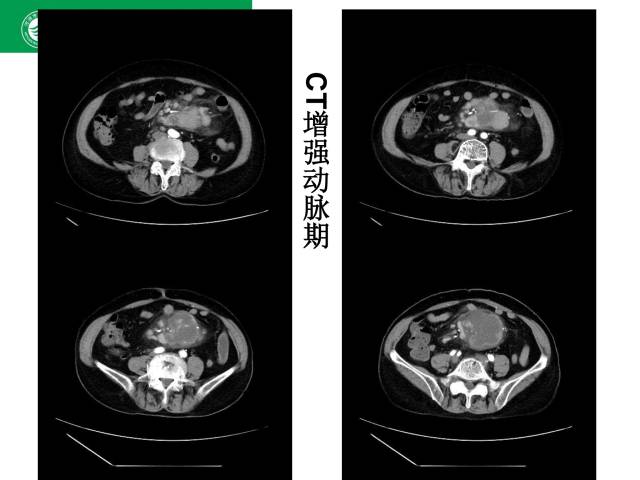 【病例】肠系膜根部淋巴瘤1例CT影像表现 【病例】肠系膜根部淋巴瘤1例CT影像表现