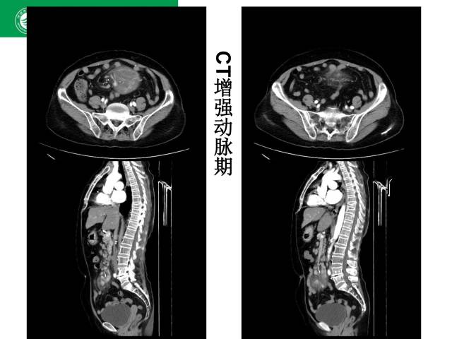 【病例】肠系膜根部淋巴瘤1例CT影像表现 【病例】肠系膜根部淋巴瘤1例CT影像表现