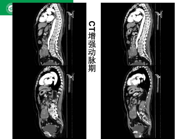 【病例】肠系膜根部淋巴瘤1例CT影像表现 【病例】肠系膜根部淋巴瘤1例CT影像表现