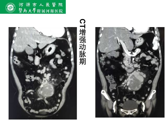 【病例】肠系膜根部淋巴瘤1例CT影像表现 【病例】肠系膜根部淋巴瘤1例CT影像表现