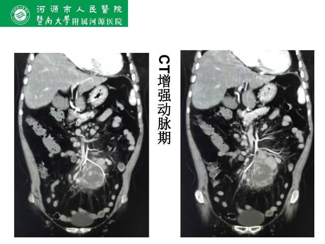 【病例】肠系膜根部淋巴瘤1例CT影像表现 【病例】肠系膜根部淋巴瘤1例CT影像表现