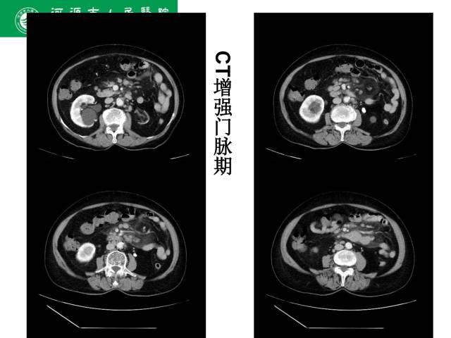 【病例】肠系膜根部淋巴瘤1例CT影像表现 【病例】肠系膜根部淋巴瘤1例CT影像表现