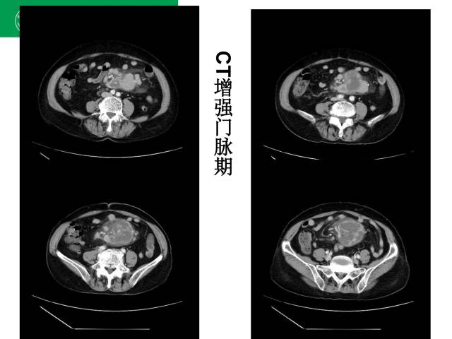 【病例】肠系膜根部淋巴瘤1例CT影像表现 【病例】肠系膜根部淋巴瘤1例CT影像表现
