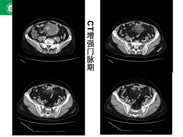 【病例】肠系膜根部淋巴瘤1例CT影像表现 【病例】肠系膜根部淋巴瘤1例CT影像表现
