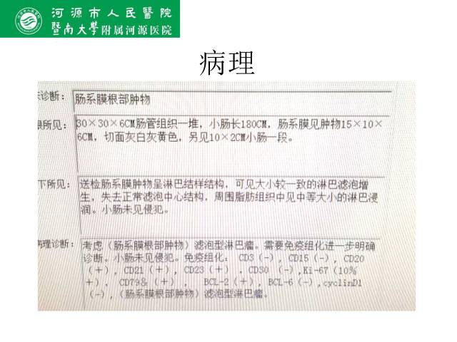 【病例】肠系膜根部淋巴瘤1例CT影像表现 【病例】肠系膜根部淋巴瘤1例CT影像表现