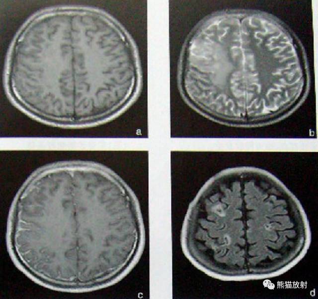 颅内感染性疾病——病毒性脑炎、颅内真菌感染
