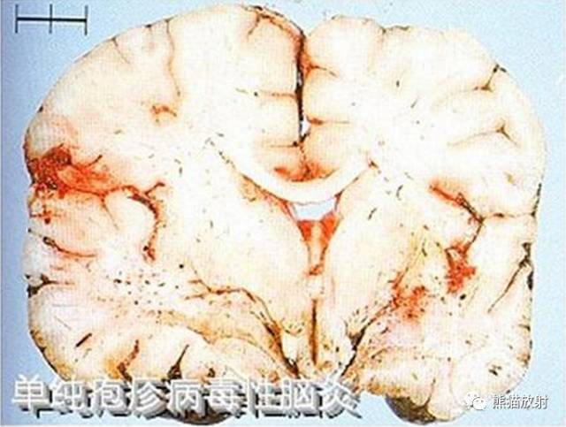 颅内感染性疾病——病毒性脑炎、颅内真菌感染 颅内感染性疾病——病毒性脑炎、颅内真菌感染