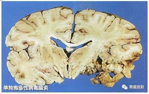 颅内感染性疾病——病毒性脑炎、颅内真菌感染 颅内感染性疾病——病毒性脑炎、颅内真菌感染
