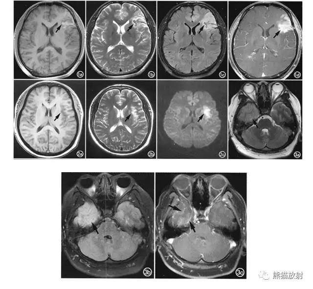 颅内感染性疾病——病毒性脑炎、颅内真菌感染 颅内感染性疾病——病毒性脑炎、颅内真菌感染