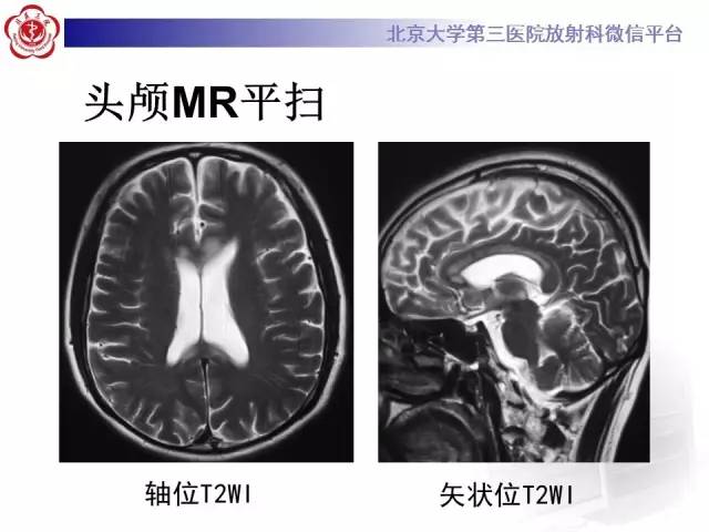【病例】原发性胼胝体变性1例MR