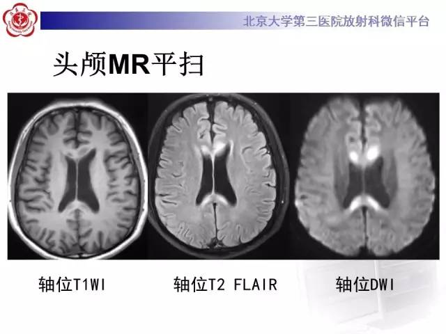 【病例】原发性胼胝体变性1例MR
