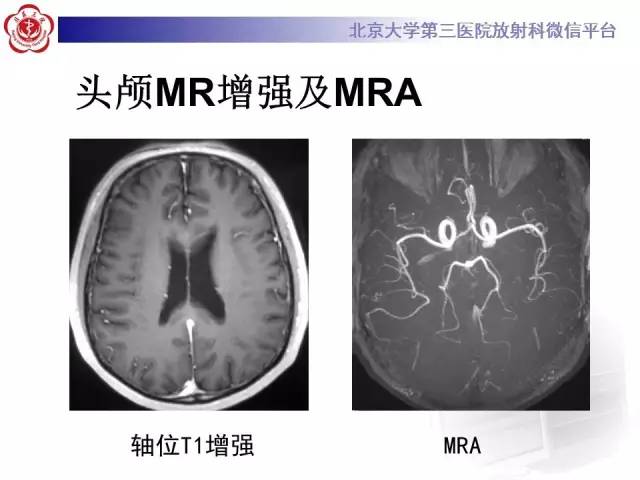 【病例】原发性胼胝体变性1例MR
