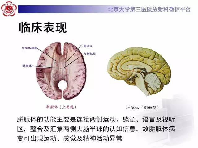 【病例】原发性胼胝体变性1例MR