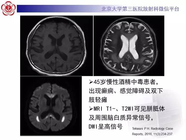 【病例】原发性胼胝体变性1例MR