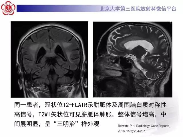 【病例】原发性胼胝体变性1例MR
