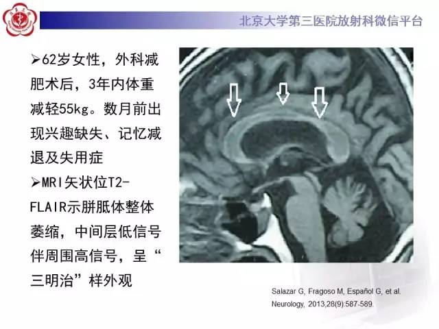 【病例】原发性胼胝体变性1例MR