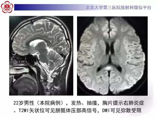 【病例】原发性胼胝体变性1例MR