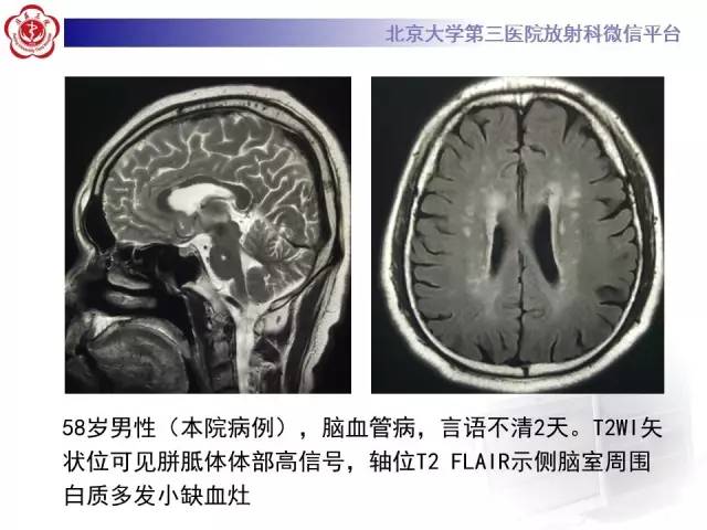 【病例】原发性胼胝体变性1例MR