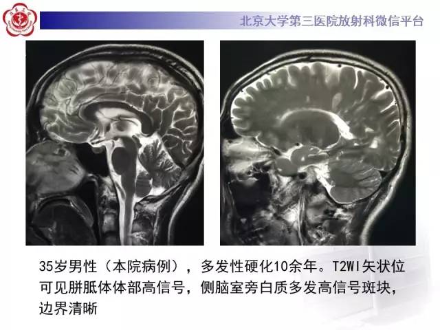 【病例】原发性胼胝体变性1例MR