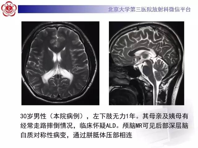 【病例】原发性胼胝体变性1例MR