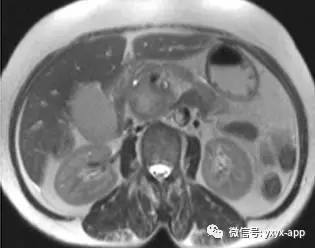 【病例】胰头癌1例MRI及CT影像诊断分析 【病例】胰头癌1例MRI及CT影像诊断分析