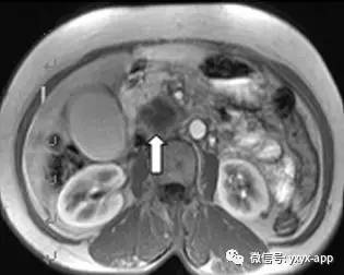 【病例】胰头癌1例MRI及CT影像诊断分析 【病例】胰头癌1例MRI及CT影像诊断分析