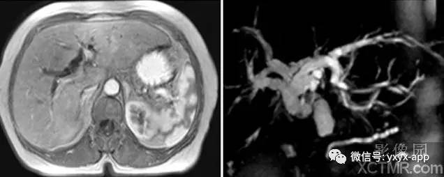 【病例】胰头癌1例MRI及CT影像诊断分析 【病例】胰头癌1例MRI及CT影像诊断分析