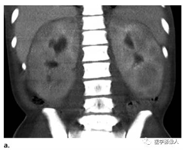 血液系统疾病累及肾脏、肾周组织影像学表现 血液系统疾病累及肾脏、肾周组织影像学表现