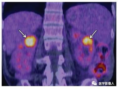 血液系统疾病累及肾脏、肾周组织影像学表现 血液系统疾病累及肾脏、肾周组织影像学表现