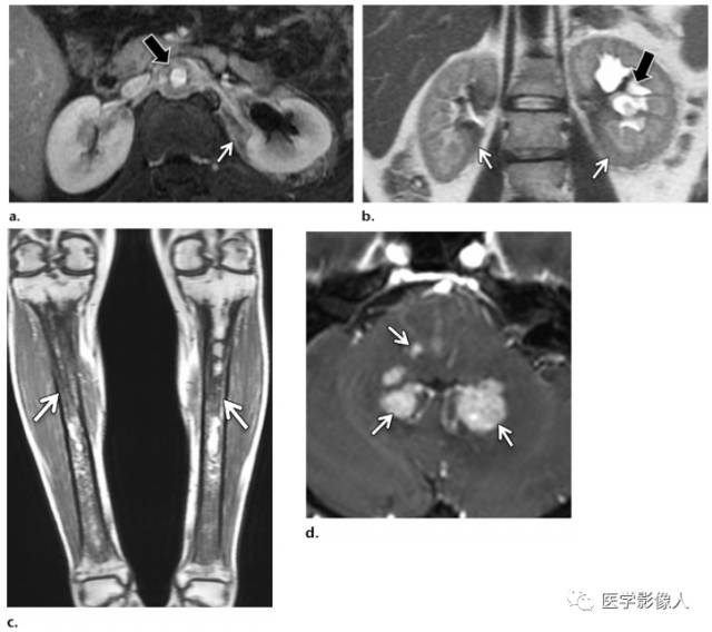 血液系统疾病累及肾脏、肾周组织影像学表现 血液系统疾病累及肾脏、肾周组织影像学表现