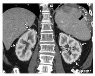 血液系统疾病累及肾脏、肾周组织影像学表现 血液系统疾病累及肾脏、肾周组织影像学表现
