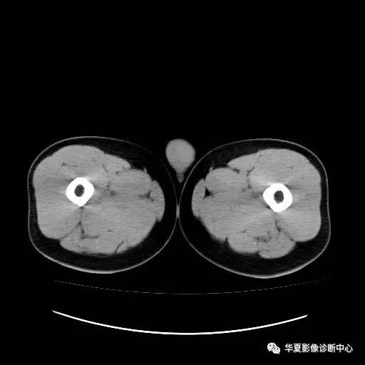 【病例】睾丸淋巴瘤1例CT 【病例】睾丸淋巴瘤1例CT