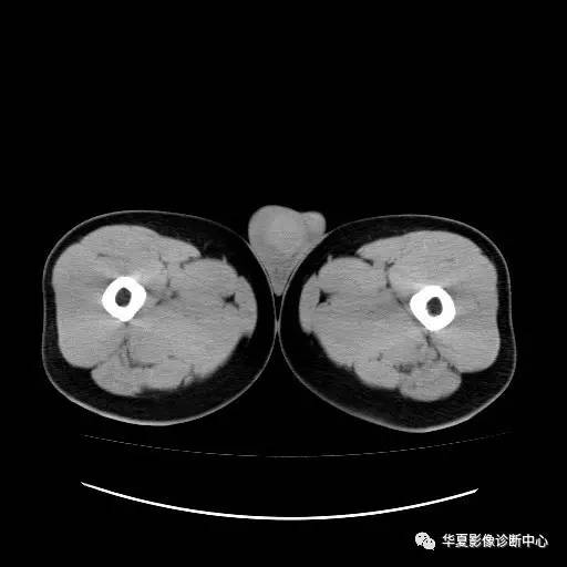 【病例】睾丸淋巴瘤1例CT 【病例】睾丸淋巴瘤1例CT