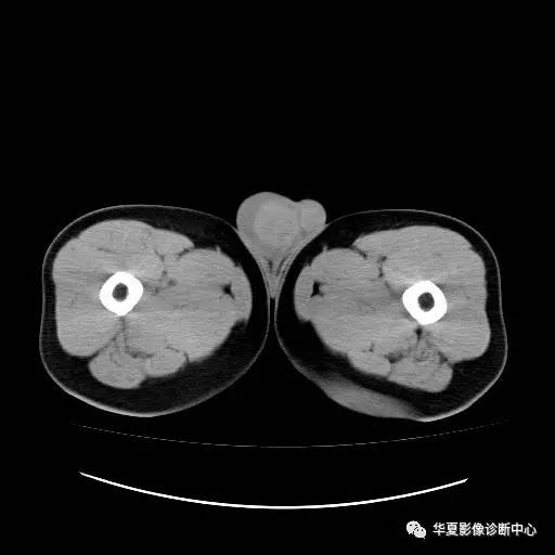 【病例】睾丸淋巴瘤1例CT 【病例】睾丸淋巴瘤1例CT
