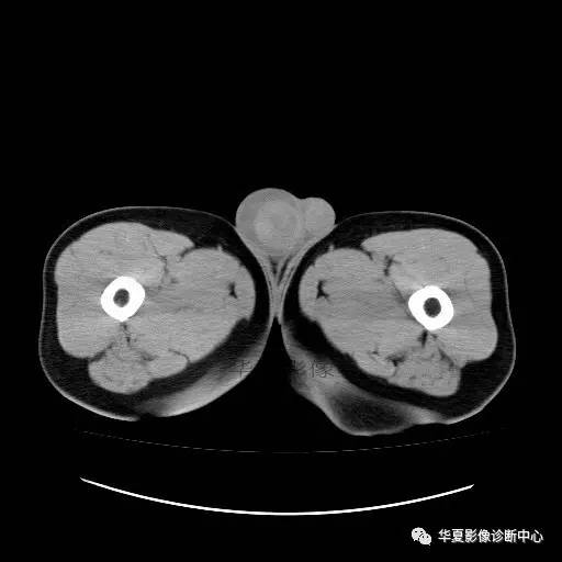 【病例】睾丸淋巴瘤1例CT 【病例】睾丸淋巴瘤1例CT