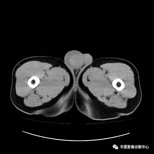 【病例】睾丸淋巴瘤1例CT 【病例】睾丸淋巴瘤1例CT