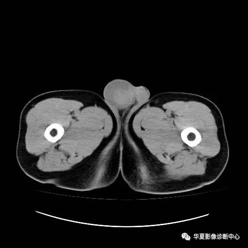 【病例】睾丸淋巴瘤1例CT 【病例】睾丸淋巴瘤1例CT