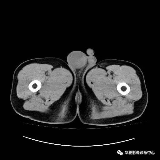 【病例】睾丸淋巴瘤1例CT 【病例】睾丸淋巴瘤1例CT