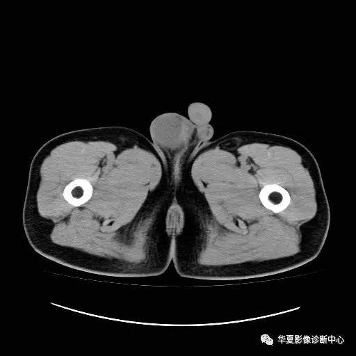 【病例】睾丸淋巴瘤1例CT 【病例】睾丸淋巴瘤1例CT