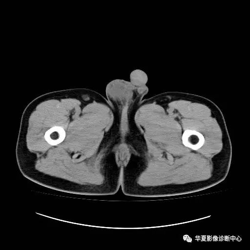 【病例】睾丸淋巴瘤1例CT 【病例】睾丸淋巴瘤1例CT