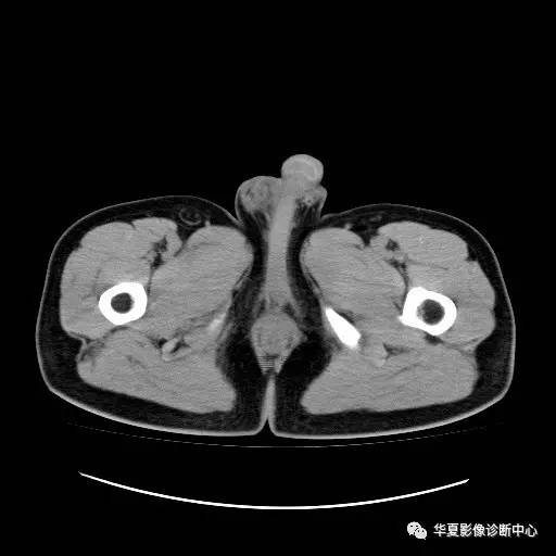 【病例】睾丸淋巴瘤1例CT 【病例】睾丸淋巴瘤1例CT