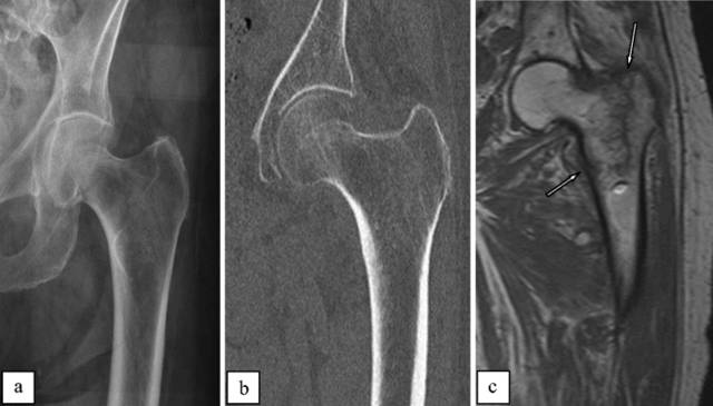 可疑髋部骨折:为什么首选 MRI,而不是 CT 可疑髋部骨折:为什么首选 MRI,而不是 CT