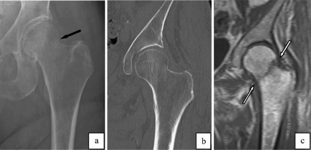可疑髋部骨折:为什么首选 MRI,而不是 CT 可疑髋部骨折:为什么首选 MRI,而不是 CT