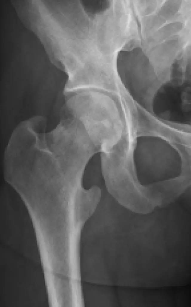 可疑髋部骨折:为什么首选 MRI,而不是 CT 可疑髋部骨折:为什么首选 MRI,而不是 CT