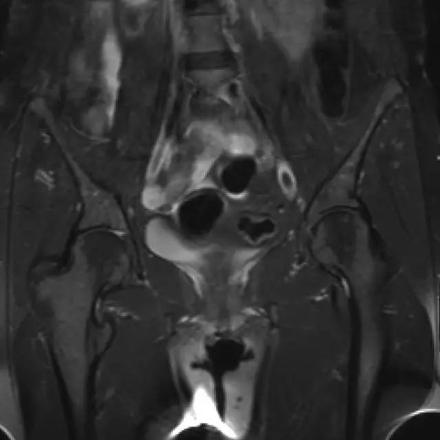 可疑髋部骨折:为什么首选 MRI,而不是 CT 可疑髋部骨折:为什么首选 MRI,而不是 CT