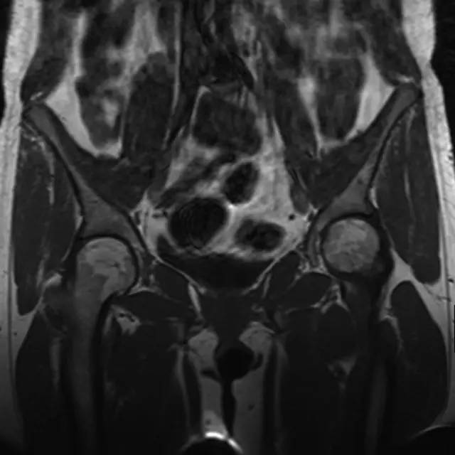 可疑髋部骨折:为什么首选 MRI,而不是 CT 可疑髋部骨折:为什么首选 MRI,而不是 CT