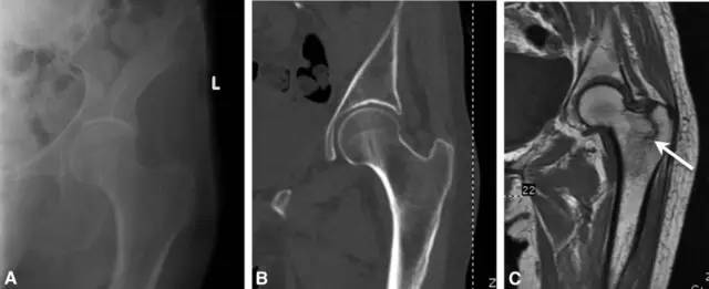 可疑髋部骨折:为什么首选 MRI,而不是 CT 可疑髋部骨折:为什么首选 MRI,而不是 CT